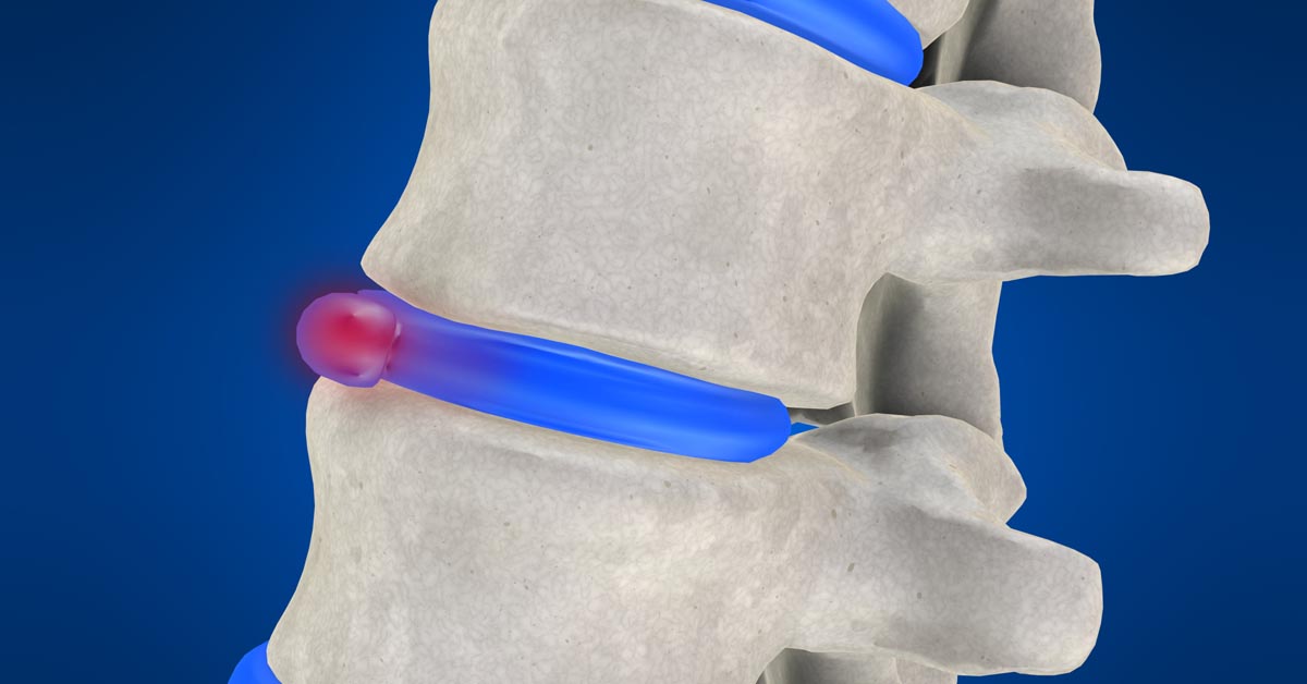 Cary non-surgical disc herniation treatment